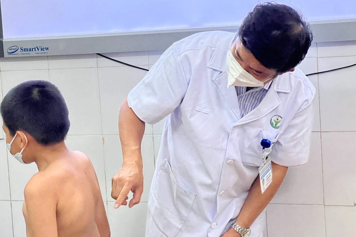 Hoảng hồn phát hiện con cong vẹo cột sống sau 2 năm nghỉ dịch - 2 Hoảng hồn phát hiện con cong vẹo cột sống sau 2 năm nghỉ dịch - 2