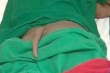 Kì dị thanh niên mọc “đuôi khỉ” dài nhất thế giới sau lưng