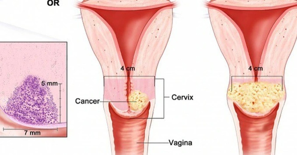 Tiên lượng điều trị ung thư cổ tử cung - 1 Tiên lượng điều trị ung thư cổ tử cung - 1