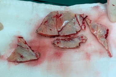 Bị đánh vỡ hộp sọ, nạn nhân may mắn thoát chết