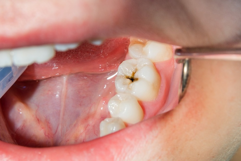 Kem đánh răng Dentist H2H - giải pháp mới trong chăm sóc, bảo vệ răng miệng - 1 Kem đánh răng Dentist H2H - giải pháp mới trong chăm sóc, bảo vệ răng miệng - 1