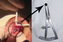 Cấp cứu nam sinh 15 tuổi bị viên bi sắt bắn và găm vào mắt nhiều ngày