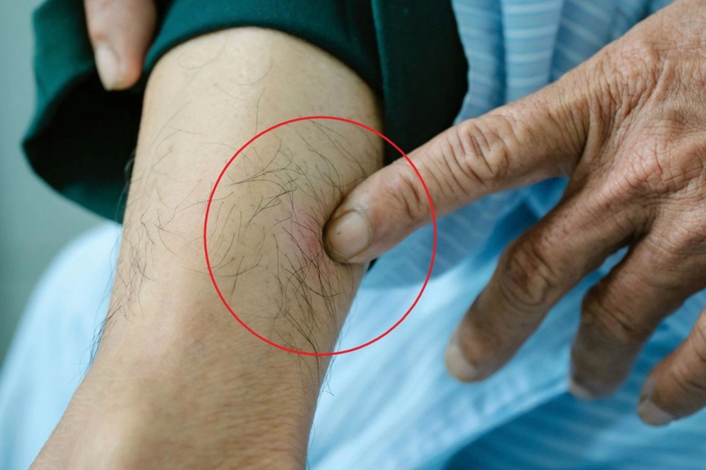 Vì sao sốc phản vệ nguy kịch vì kiến ba khoang đốt? - 1 Vì sao sốc phản vệ nguy kịch vì kiến ba khoang đốt? - 1