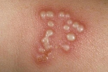 Nhiễm virus Herpes, bỏng rát sau đi làm đẹp