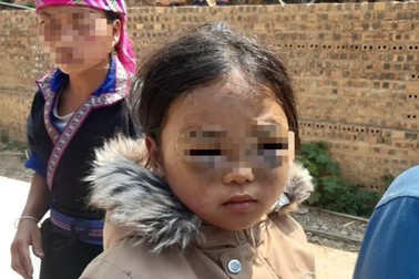 Công an vào cuộc vụ bé gái lớp 1 nghi bị cô giáo đánh tím mắt ở Yên Bái