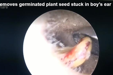 Bác sĩ loại bỏ hạt đậu nảy mầm trong tai em bé 6 tuổi