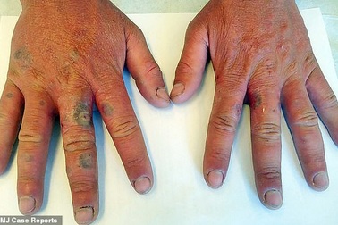 Rộp tay vì không rửa tay suốt 10 tiếng sau khi vắt nước chanh