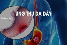 Ung thư dạ dày ngày càng gia tăng