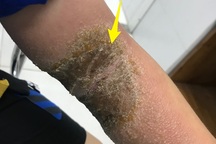 Bó thuốc trị gãy xương, cánh tay cậu bé bị nhiễm trùng nặng