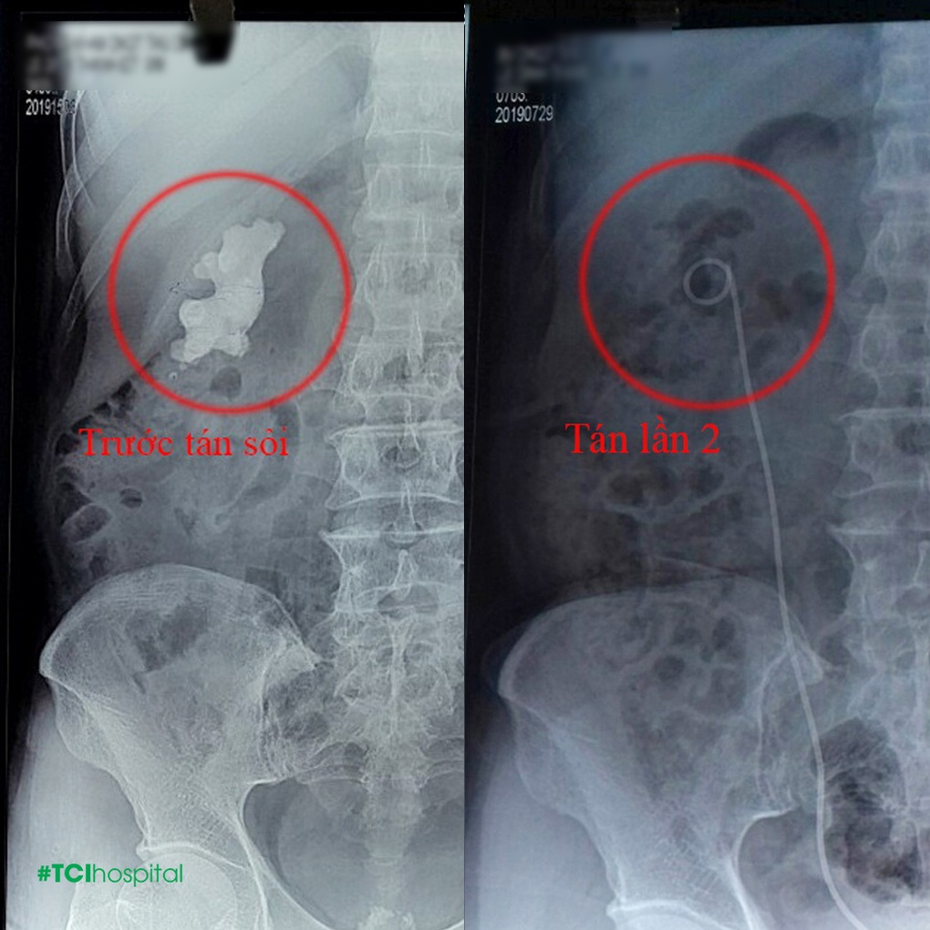 Cơ hội tán sỏi tiết niệu miễn phí, ưu đãi tới 50% tại bệnh viện quốc tế - 1 Cơ hội tán sỏi tiết niệu miễn phí, ưu đãi tới 50% tại bệnh viện quốc tế - 1