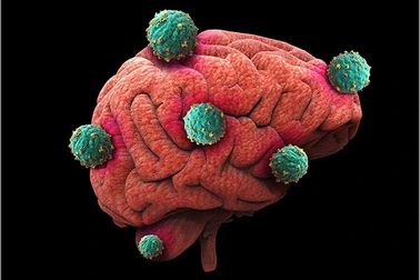 Các triệu chứng của u não ác tính giai đoạn cuối