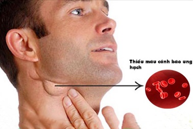 Tỷ lệ sống sau 5 năm cho u lympho Hodgkin