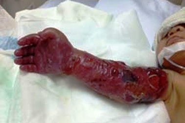 Cứu cánh tay hoại tử của bé gái sinh non