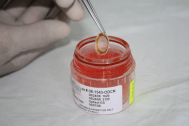 Giác mạc được hiến quá ít so với nhu cầu