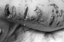 Bé 3 tuổi hoảng loạn vì chó pitbull giật đứt xích cắn nát đùi