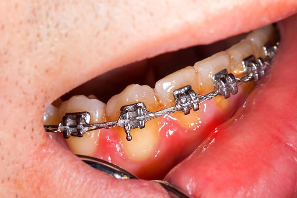 Cơn sốt Niềng răng chưa đến 10 triệu đồng? Thực hư ra sao? - 1 Cơn sốt Niềng răng chưa đến 10 triệu đồng? Thực hư ra sao? - 1