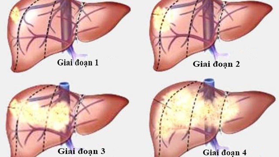 Nguyên nhân và yếu tố nguy cơ