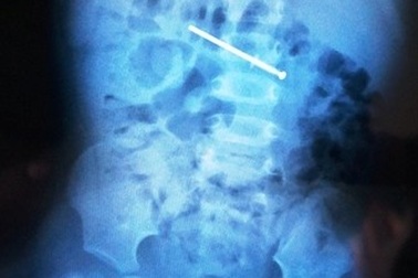 Nuốt cây đinh bố đưa chơi, bé 18 tháng tuổi phải mổ nội soi