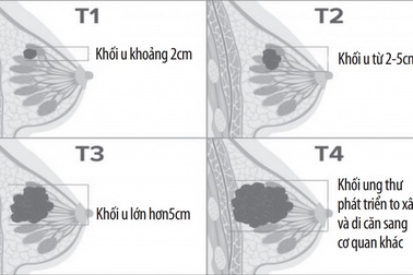 Phân biệt u vú lành tính và ung thư vú