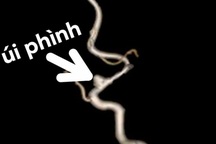 Bé trai mới 3 tuổi đã bị đột quỵ vì dị dạng mạch máu