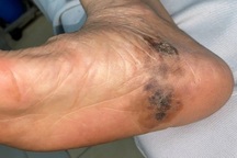 Đốm lạ trên da cảnh báo loại ung thư ác tính di căn nhanh