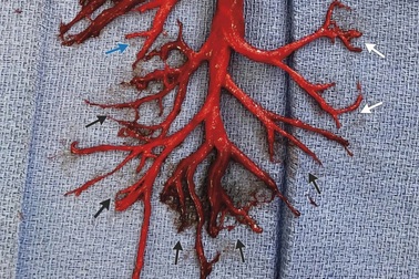 Giải mã cục máu đông trở thành hình ảnh y học ấn tượng nhất thế kỷ 21