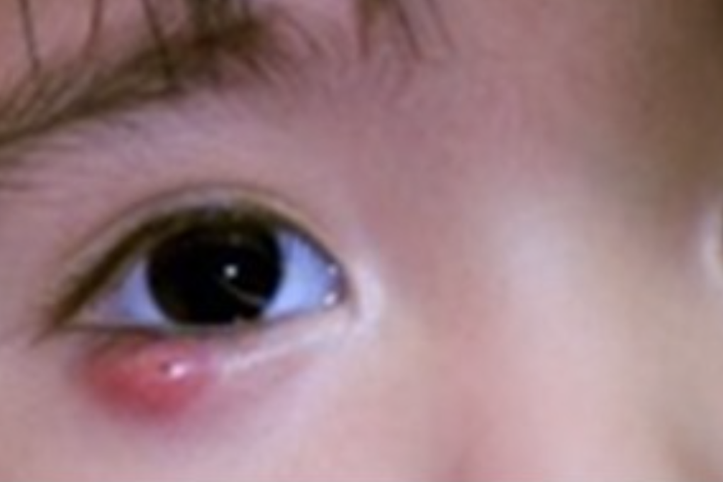 Cảnh báo: Nhiều trẻ phải vào bệnh viện nhi đồng ở TPHCM vì bị chắp lẹo mắt - 1 Cảnh báo: Nhiều trẻ phải vào bệnh viện nhi đồng ở TPHCM vì bị chắp lẹo mắt - 1