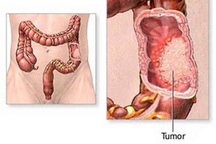 Ung thư đại trực tràng: Phát hiện sớm, 90% là chữa khỏi