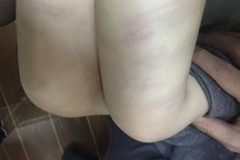 Bé gái hơn 2 tuổi bị cô giáo mầm non đánh bầm tím đùi