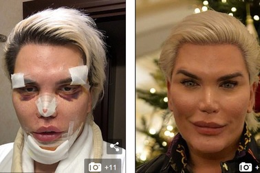 "Búp bê Ken" Rodrigo Alves lộ mặt sưng phồng sau ca "dao kéo"