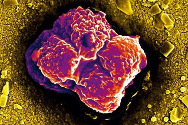 Tại sao tế bào ung thư lan rất nhanh khắp cơ thể?