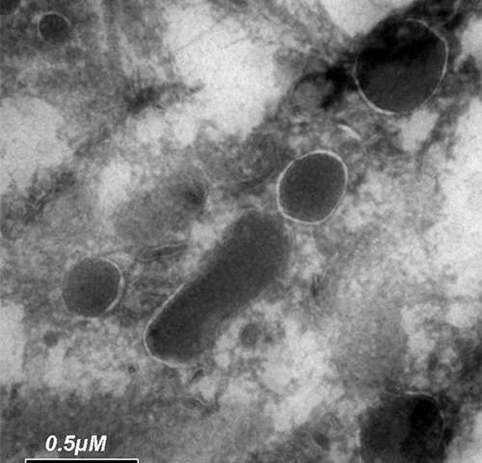 Phát hiện rùng mình về sinh vật sống trong tế bào ung thư - 1 Phát hiện rùng mình về sinh vật sống trong tế bào ung thư - 1