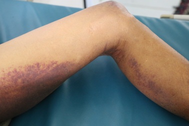 Cứu sống cụ ông 92 tuổi bị rắn độc cắn