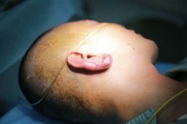 Chàng trai gánh hậu quả nặng nề vì sửa tai cho "hợp phong thủy"