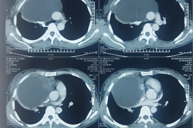 Mổ lấy thành công khối u lớn chèn ép tim, phổi nữ bệnh nhân