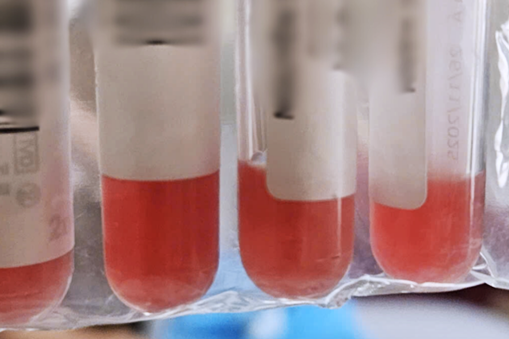 Người phụ nữ ở TPHCM bỗng cứng cổ, liên tục nôn ói nguy kịch khi đi vệ sinh - 1 Người phụ nữ ở TPHCM bỗng cứng cổ, liên tục nôn ói nguy kịch khi đi vệ sinh - 1