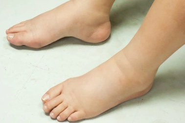 Người bệnh ung thư cần làm gì khi bị phù nề, cổ trướng