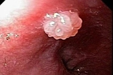 Virus HPV có gây ung thư thực quản?
