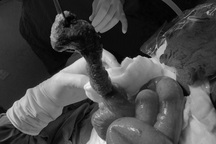 Bé gái 8 tuổi bị tắc ruột vì mắc hội chứng "công chúa tóc mây"