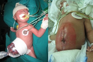 Phẫu thuật thành công ca hở thành bụng hiếm