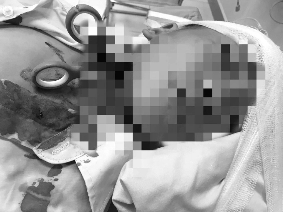 Bé trai 7 tuổi nhập viện với chiếc kéo đâm xuyên vào cổ - 1