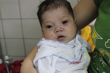 Nhịp thở khó khăn của bé 7 tháng tuổi bị bệnh tim bẩm sinh