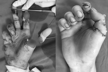 Nối ngón tay cái bị chém đứt rời cho người đàn ông ở Hà Nội