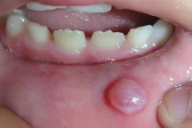 Môi nổi u mềm bằng hạt đậu có phải là dấu hiệu ung thư?