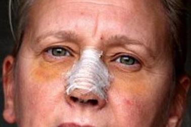 Gãy mũi vì hít bụi tóc