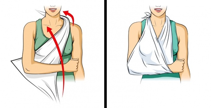 Sơ cứu khi bị thương. Những giây phút đầu tiên khi tai nạn xảy ra và trước khi xe cứu thương tới cực kỳ quan trọng. Băng bó vết thương đúng trong một số trường hợp còn cứu sống cuộc đời nạn nhân. Sau đây là những mẹo băng bó trong nhiều tình huống khác nhau. Tay hoặc chân bị gãy nên được cố định và chờ cấp cứu tới. Băng đeo cánh tay được buộc quanh cổ giữ cho tay bị gãy ở một vị trí, đồng thời là dấu hiệu cảnh báo cho người khác rằng, bạn đang bị thương.