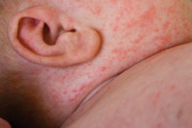 Số mắc sởi giảm hơn 400 lần so với vụ dịch 2014