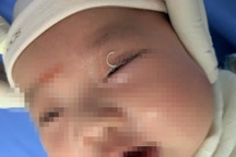 Mẹ cắt móng tay văng vào mắt, cháu bé 2 tháng tuổi lâm nguy