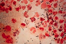 Căn bệnh hiểm làm chồng trẻ suy sụp sau một lần nhậu say đi "thư giãn"