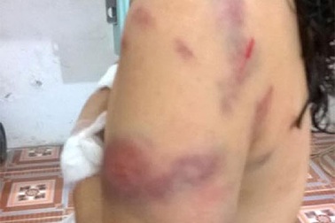 Vụ cô giáo tiểu học bị chồng cũ đánh: Thương tích 28%